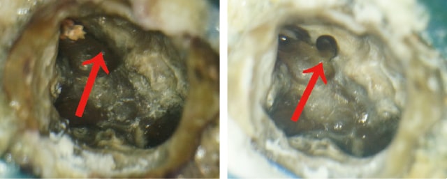 再治療：見落とされた根管の写真