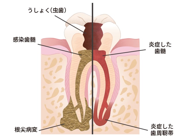 歯の神経