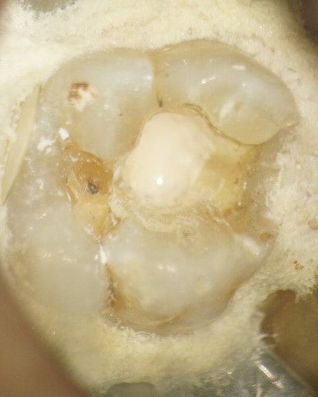 露髄部分にMTAを充填したところ